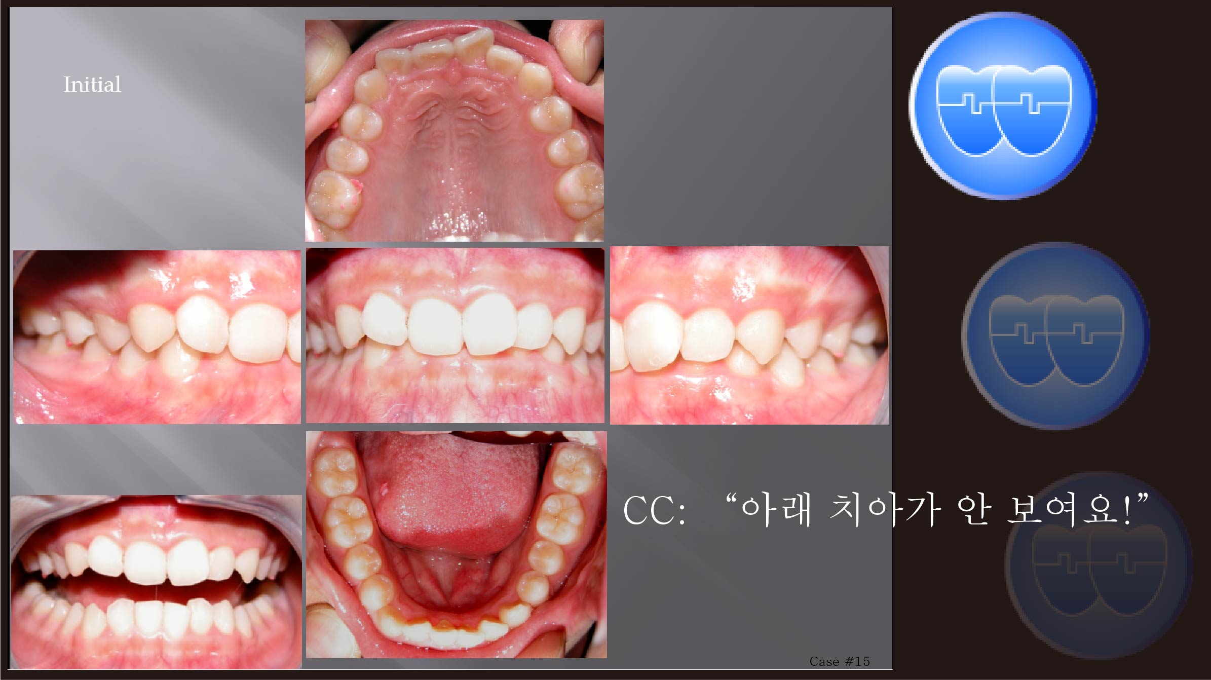 교정 Case 15.  비발치, 100% Dental Deepbite, Lower Incisor Bracket Interference, Sem #3