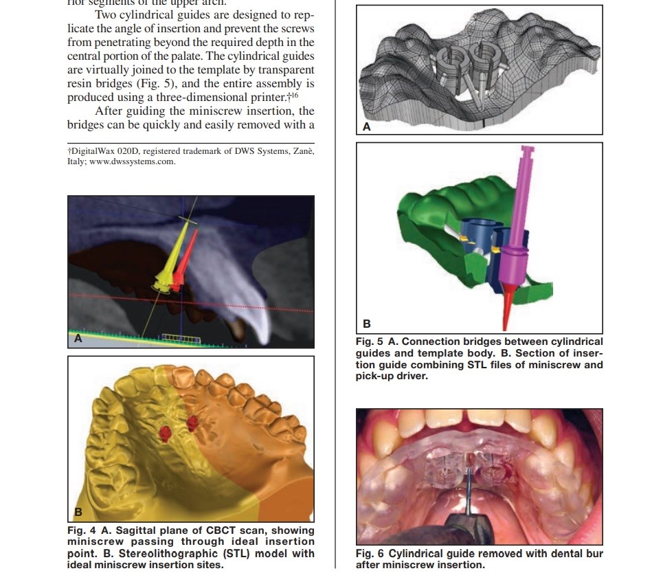 Palatal Miniscrew를 심을 때의 3차원적 고려