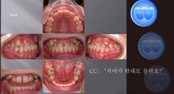교정 Case 81.  비발치, Class III, Deep Underbite, Sem #5