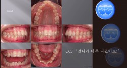 교정 Case 202.  U4L5 발치, Upper Molar Anchorage Control 실패, Upper Corticotomy, 재교정, Sem #13.7