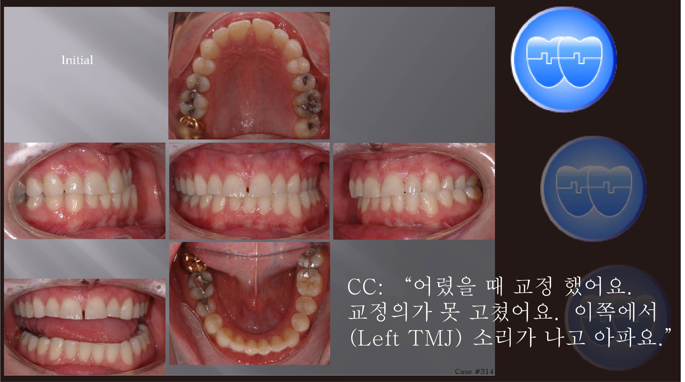 교정 Case 314.  비발치, TMJ Pain, Functional Shift, Bruxer, Sem #19