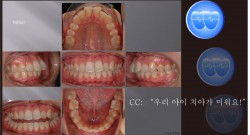 교정 Case 329.  U4L5 발치, Full Class II, Damon Brackets, Sem #10
