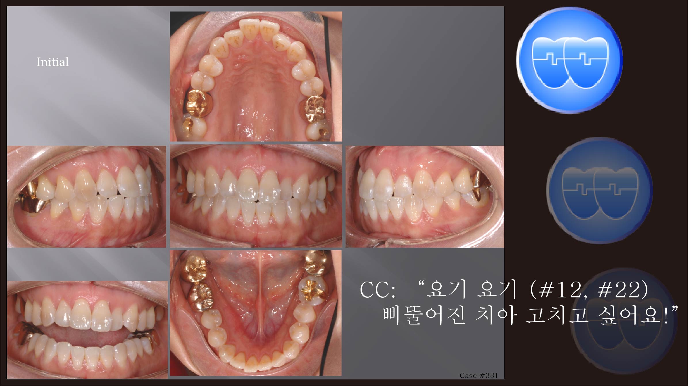교정 Case 331.  22번 검게 죽었다 다시 살아남, Wire Bending (Step-up 설명), Sem #7