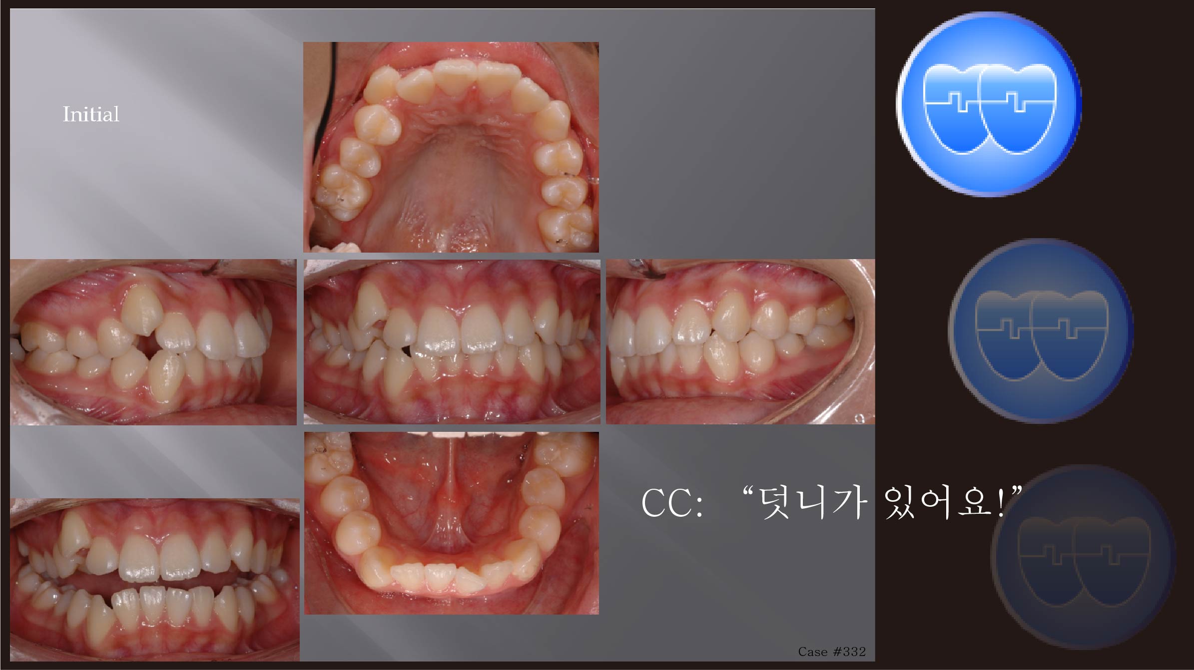 교정 Case 332.  U4L5 발치, Two-Step Mech, 진단실수, 비발치가 더 좋음, Sem #5