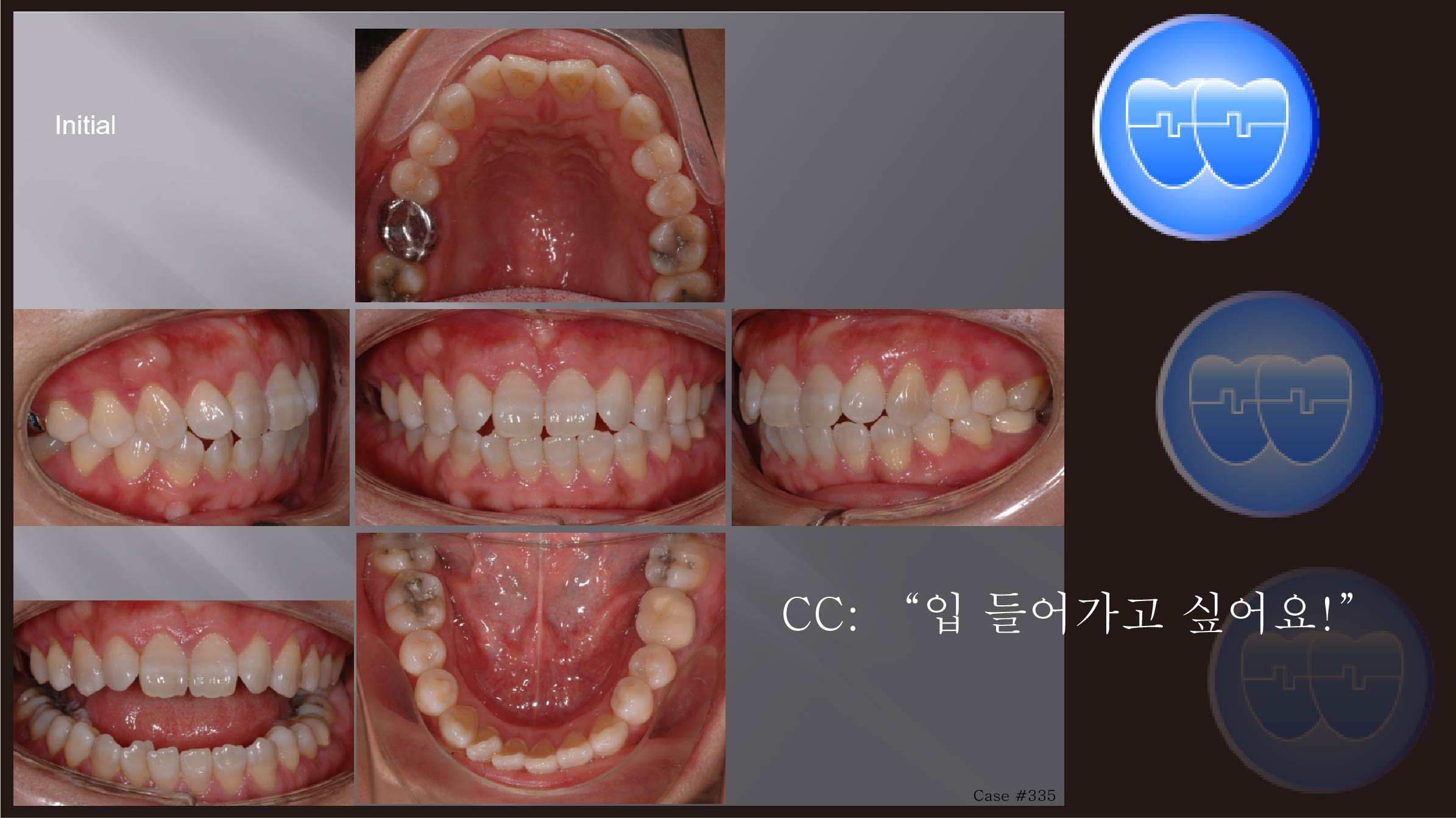 교정 Case 335.  U4L5발치 돌출입, Gingivect, Alveolaopla, Sem #10