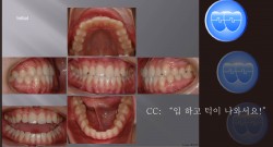 교정 Case 337.  U5L5발치, Class III, Protrusion, Lower Lingual Corticotomy, Sem #12.4