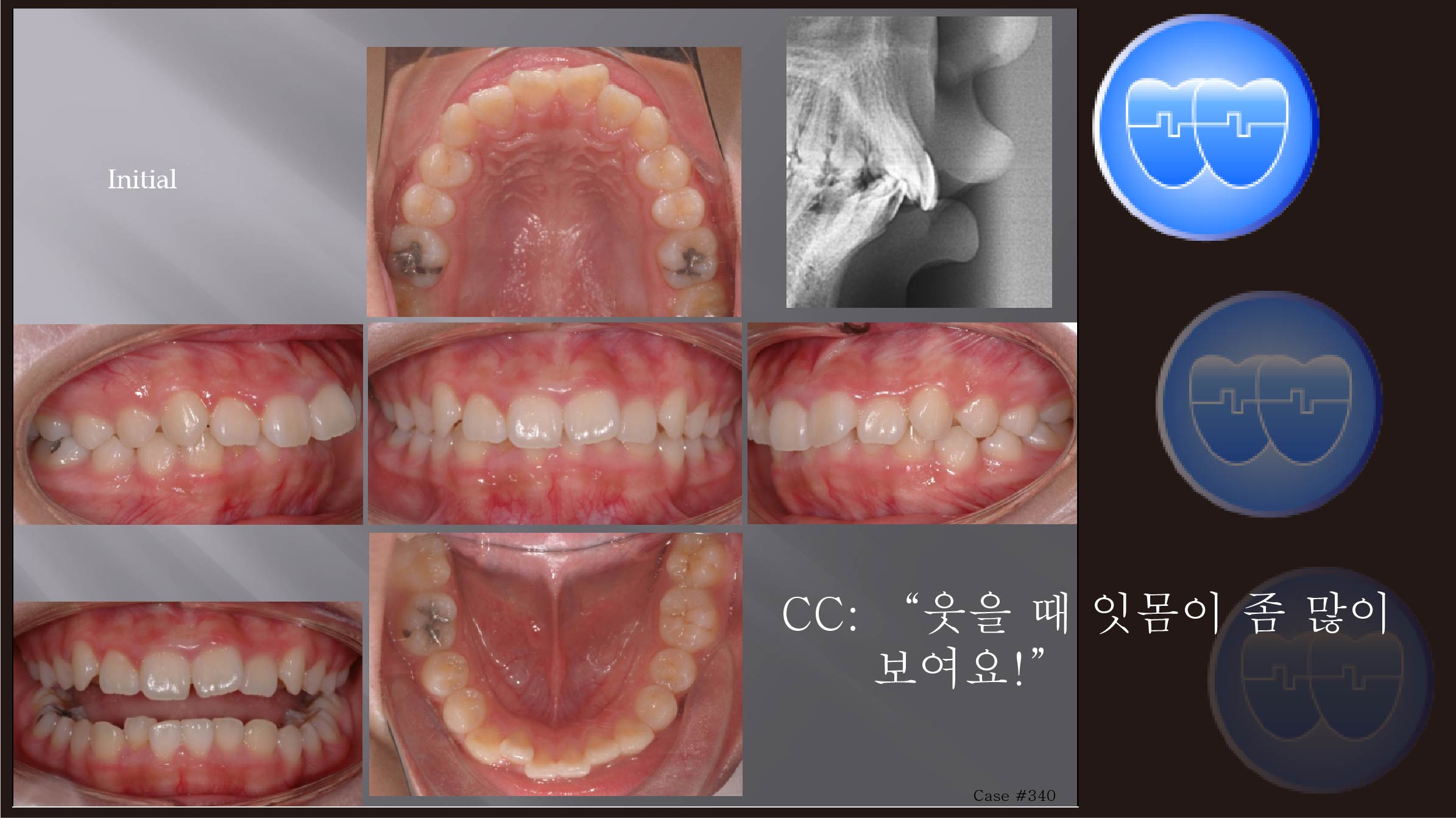 교정 Case 340.  U5 발치, Gummy Smile, Sem #7.5
