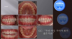교정 Case 393.  U5 발치,  돌출입, Gummy Smile, Sem #7.5