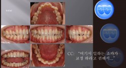 교정 Case 405.  U5L1 Extraction, Skeletal Class II, Crowding, Sem #13