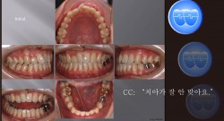 교정 Case 426.  비발치, Class III, 성인 교정, Sem #7