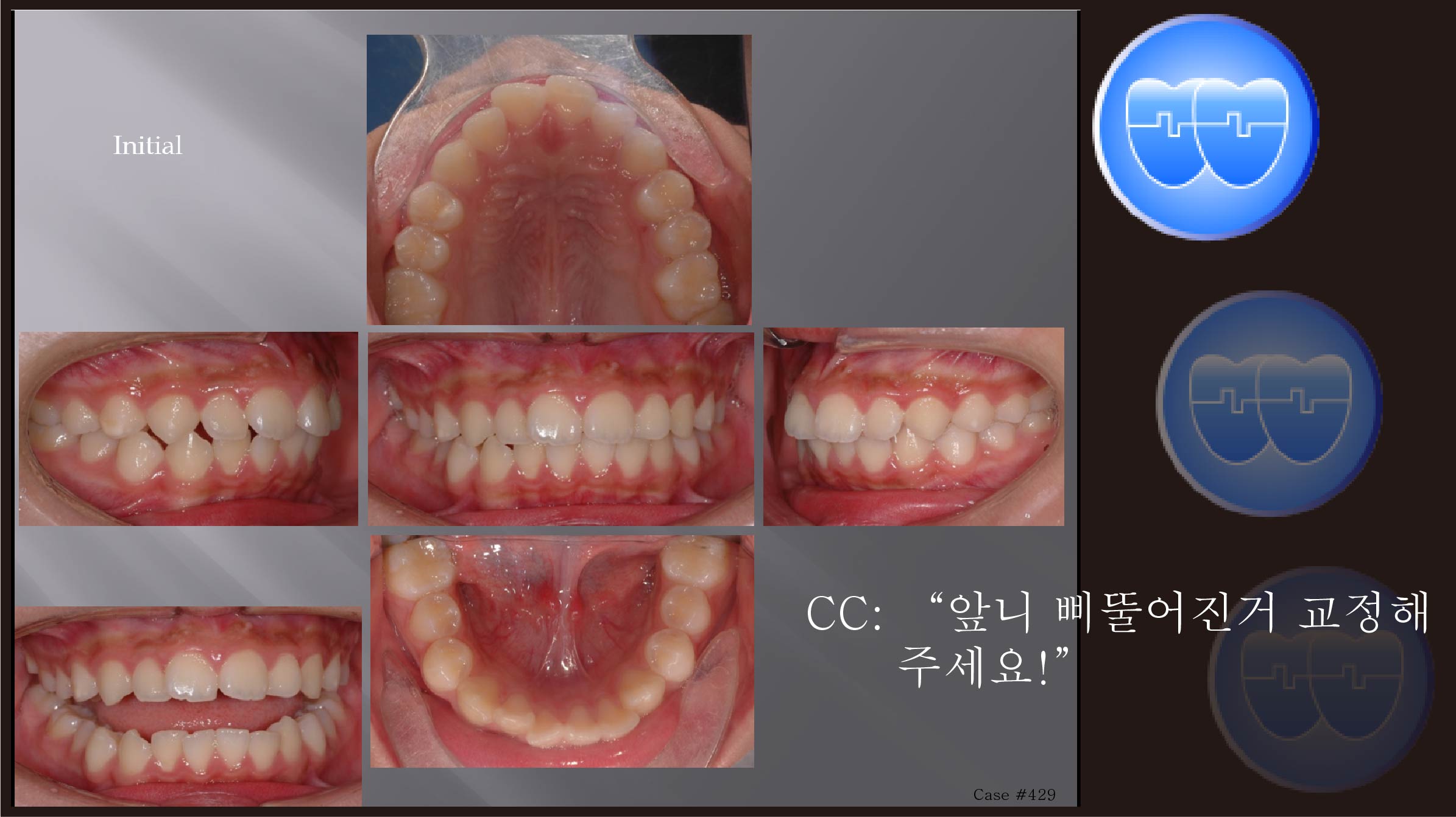 교정 Case 429.  U4L4 발치, Skeletal Class III, Sem #4