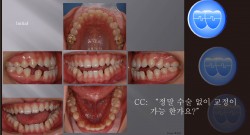 교정 Case 431. Dental Openbite, 비발치, Intrusion of Upper Molar with Miniscrews, Lower Corticotomy, Sem #7