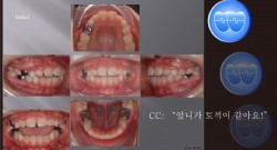 교정 Case 463.  1차 교정, Dental Openbite, Tongue Thrust, Lingual Cleats, Sem #9