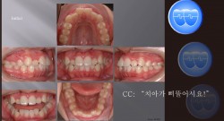교정 Case 476.  U5L4 발치, Skeletal Class II, Gummy Smile, Relapse, #23 신경죽음, Sem #7.5