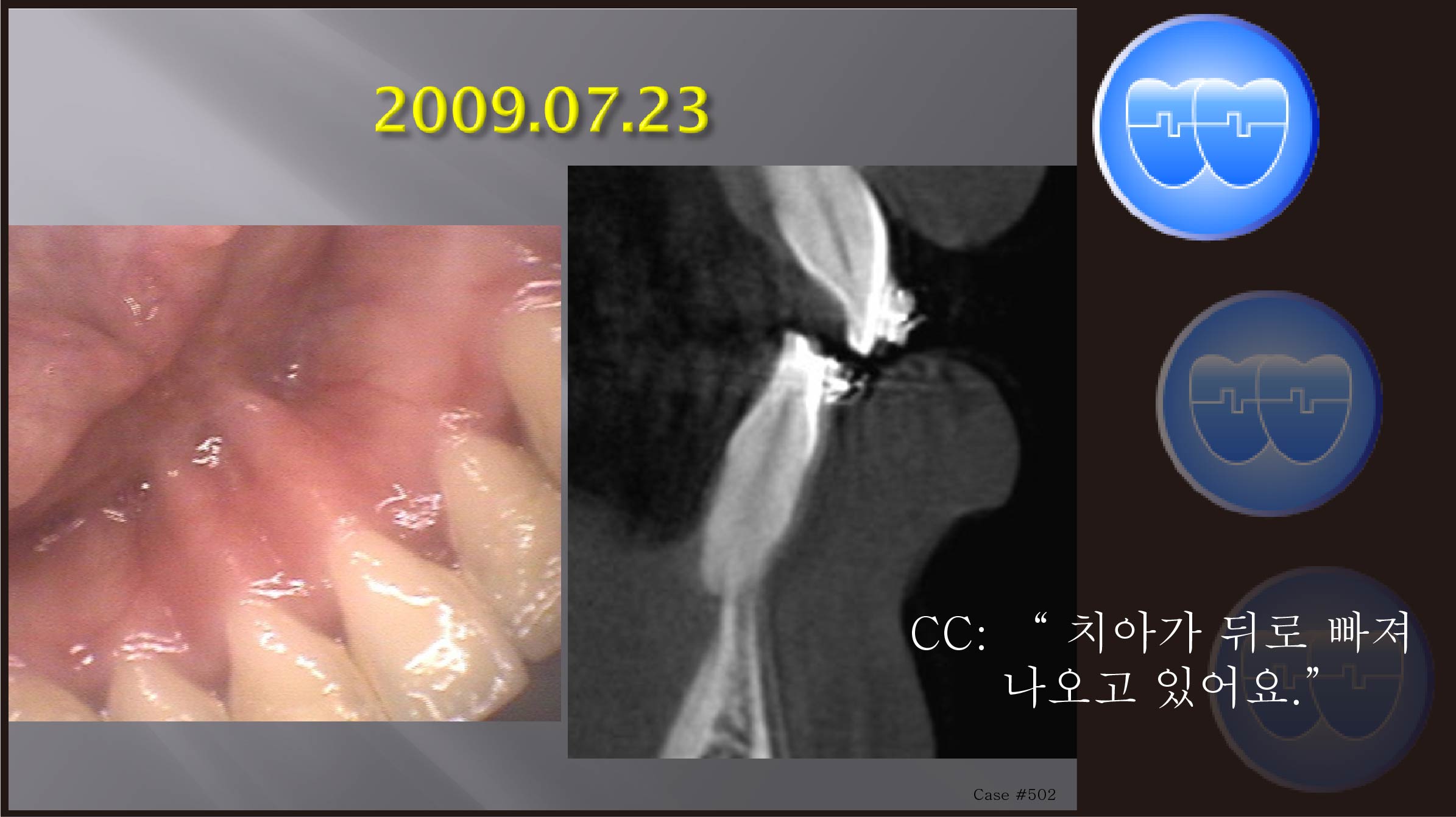 교정 Case 502.  U4L4 발치으로 교정 생긴 문제, Thin Symphysis의 위험성, Sem #7