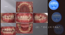 교정 Case 511.  비발치, Expansion과 Stripping으로만 Retraction, Sem #2