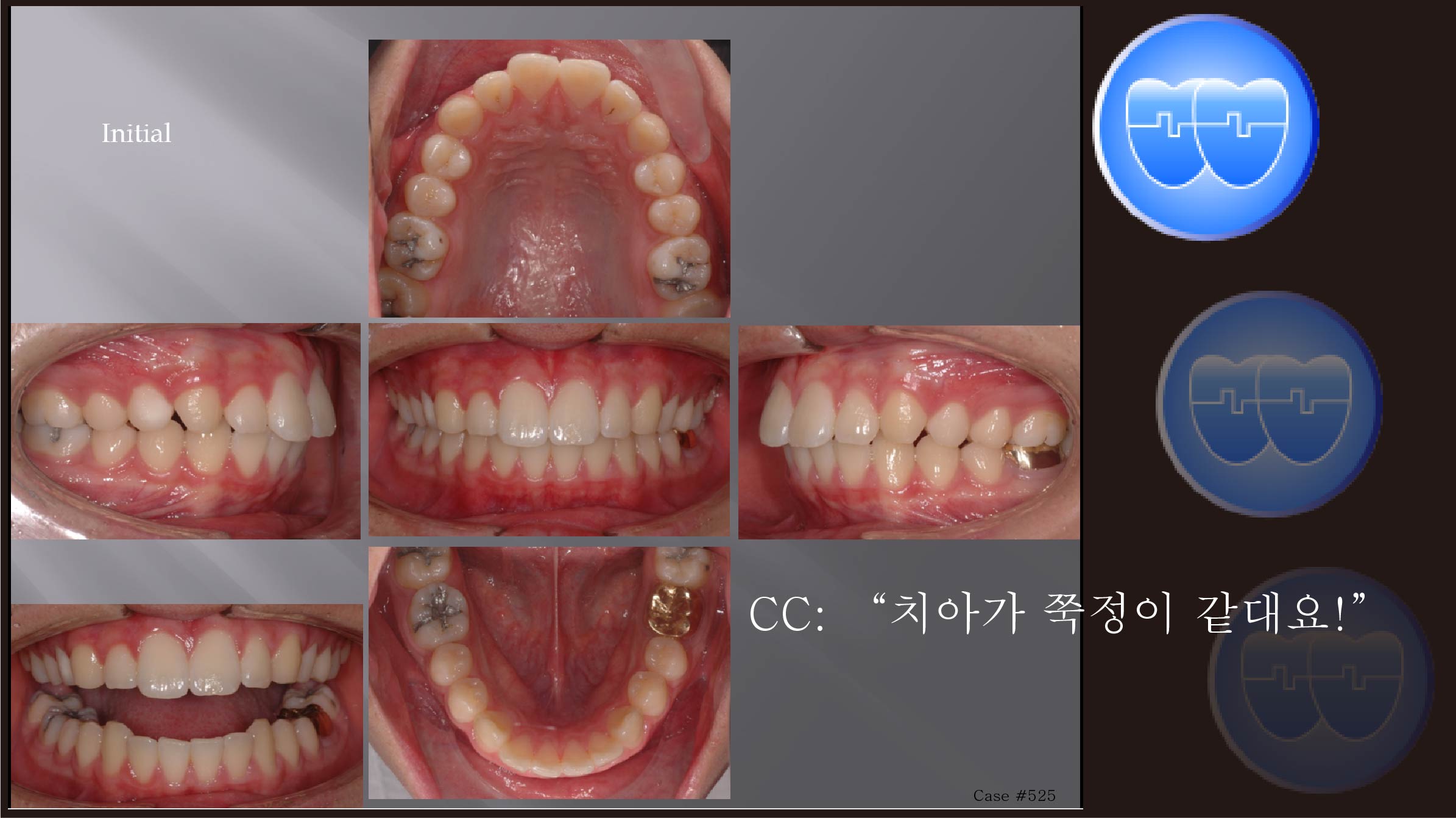 교정 Case 525.  U5L5 발치, Small Gold Crown Size Descrepancy, Sem #12.4