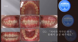 교정 Case 530.  U4L4 발치, Protrusion, U5번 앞 Miniscrew 위치, Sem #12.1