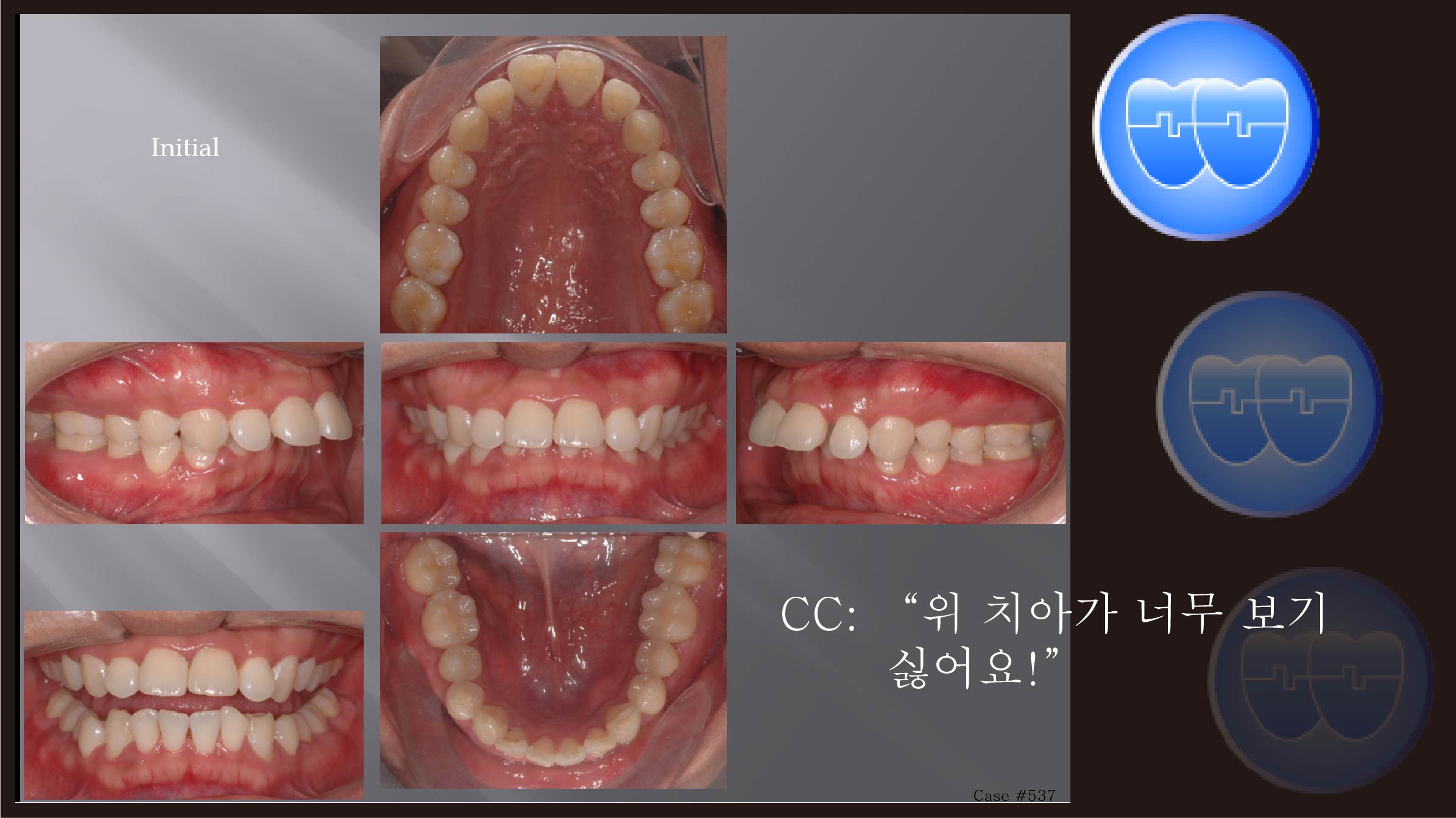 교정 Case 537.  U4 발치, Class II, Big Overjet, Dental Deepbite, Sem #12.5