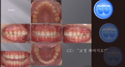 교정 Case 538.  비발치, Stripping, Gingivectomy, Class II, Sem #5