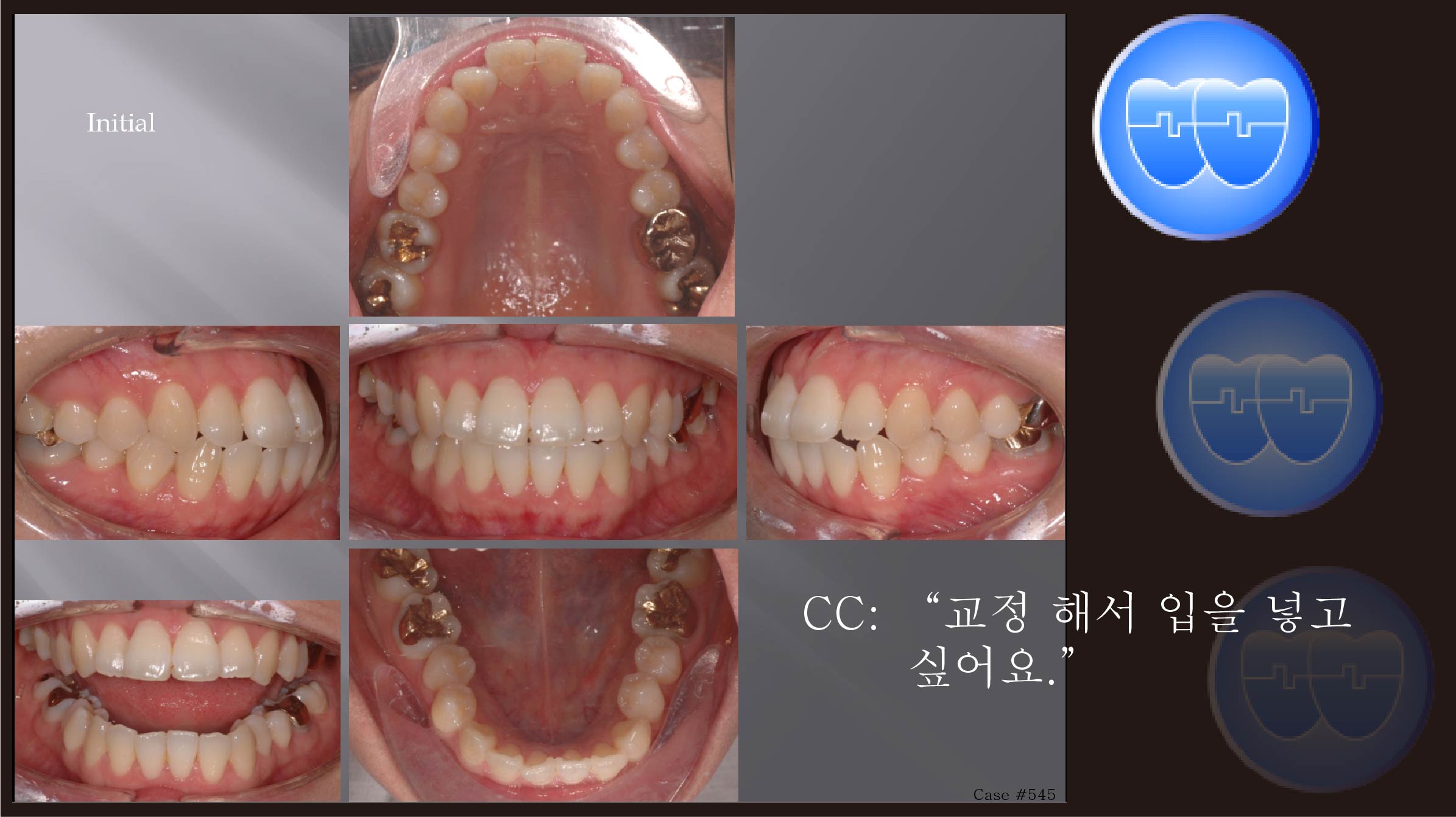 교정 Case 545.  U5L4 발치, Protrusion, Sem #12.3