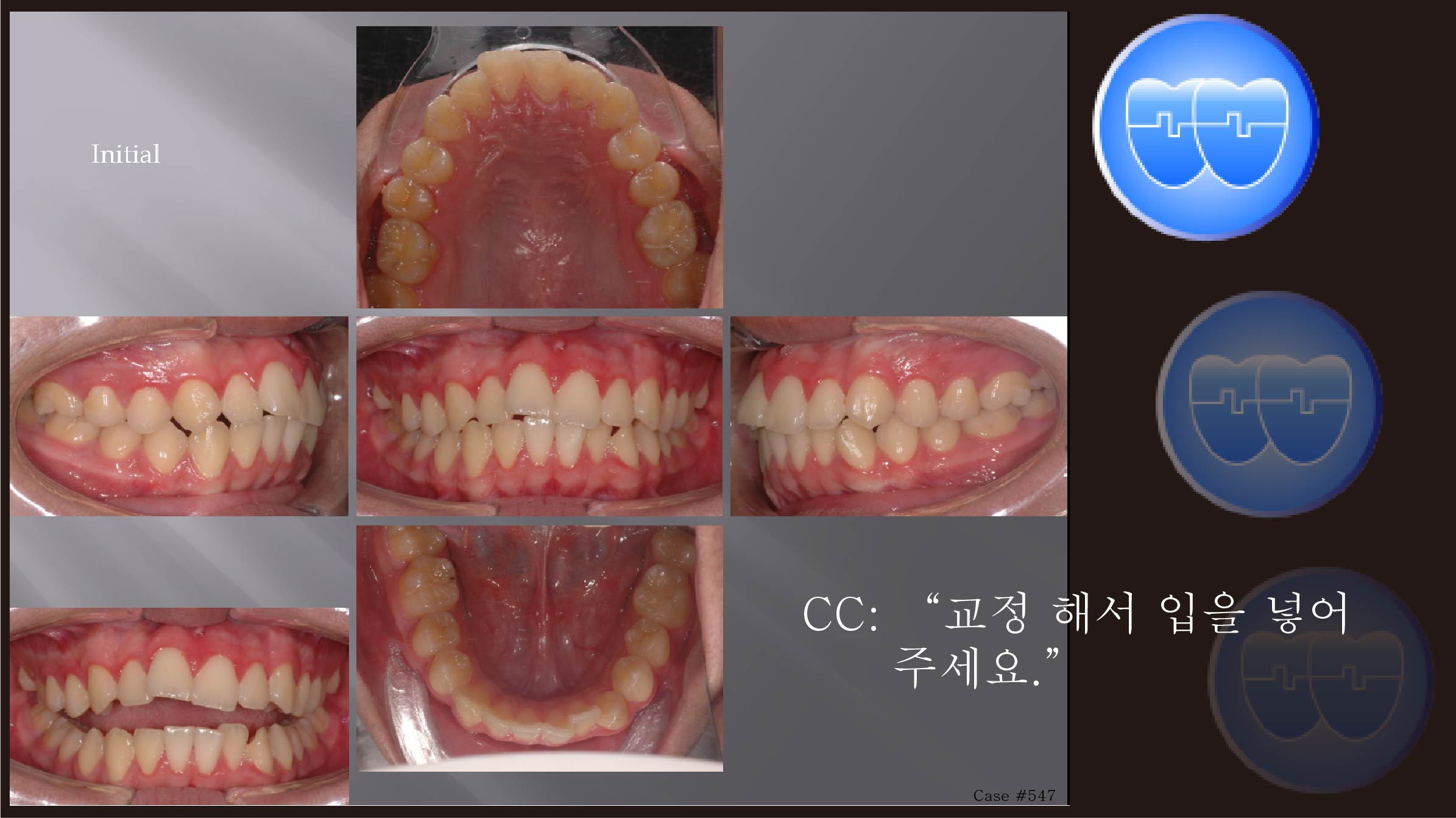 교정 Case 547.  U4L5 발치, Protrusion, Sem #12.2