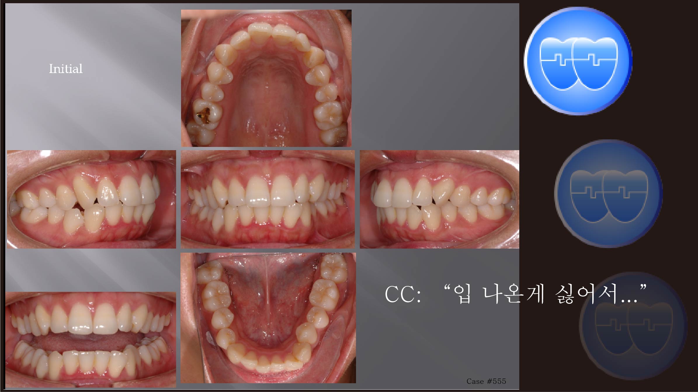 교정 Case 555.  U5L4 발치, Class II, Protrusion, Short Root #34, Sem 12.3
