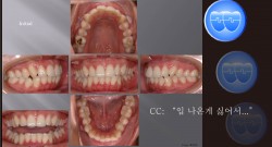 교정 Case 555.  U5L4 발치, Class II, Protrusion, Short Root #34, Sem 12.3