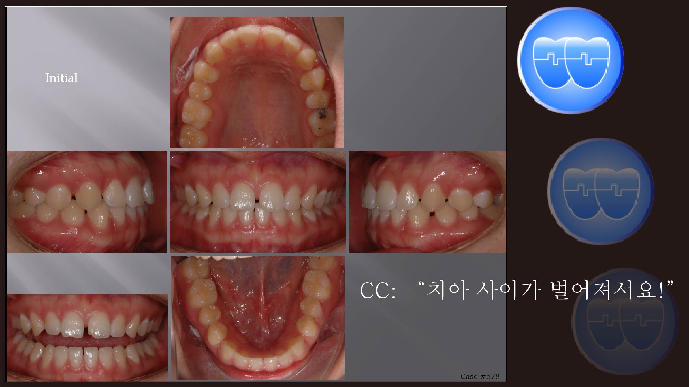 교정 Case 578.  비발치, Space Control 방법, Gingivectomy, Sem #11