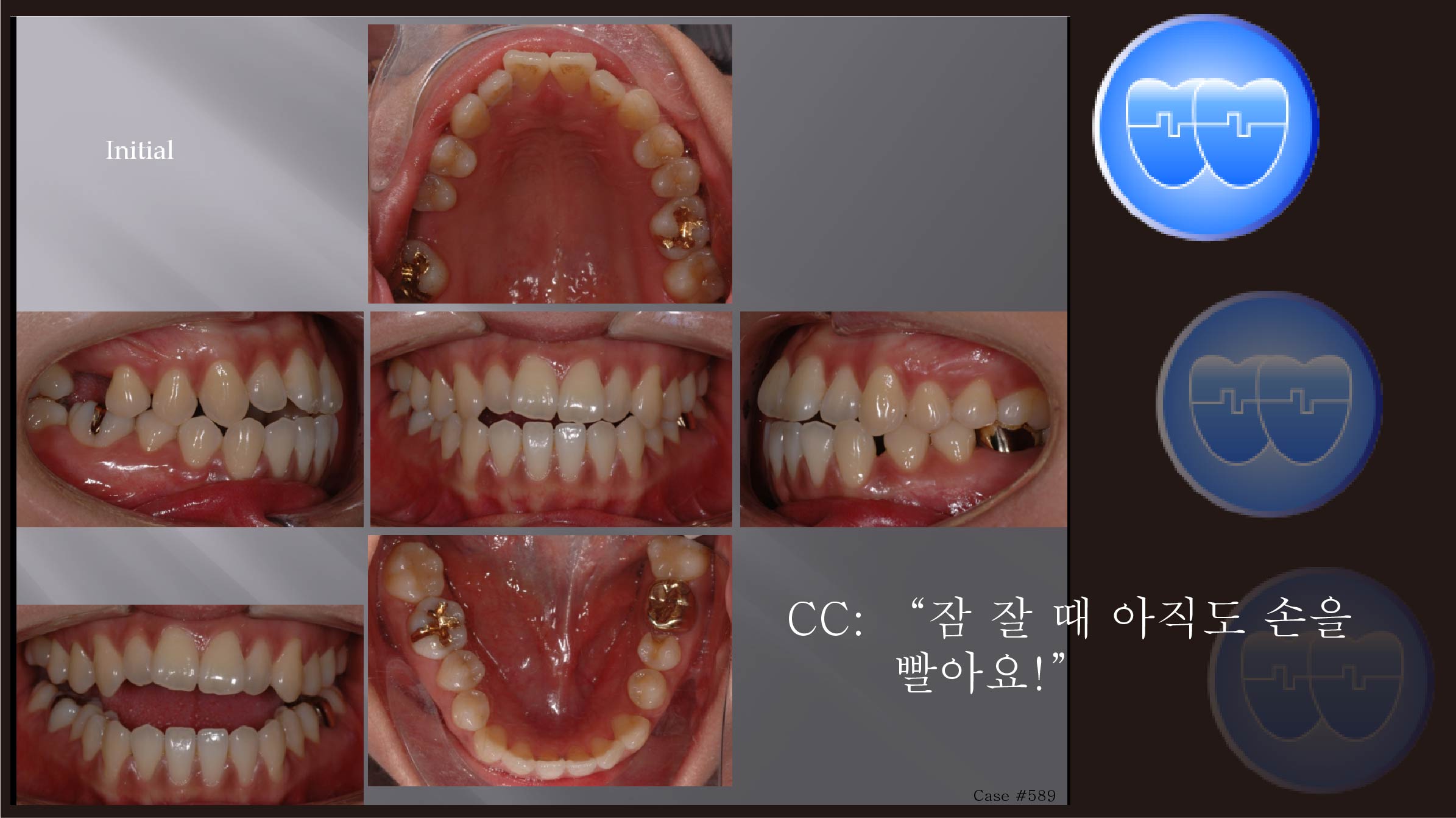 교정 Case 589.  비대칭 발치(16,25,36,44), Dental Midline, Thumb Sucking, Sem #13.2