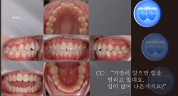 교정 Case 598.  U5L5 발치, 의심스러운 Long Face, Sem #10