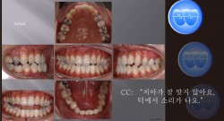 교정 Case 615.  비대칭 Upper Arch, Class III, Midline Correction, Sem #6