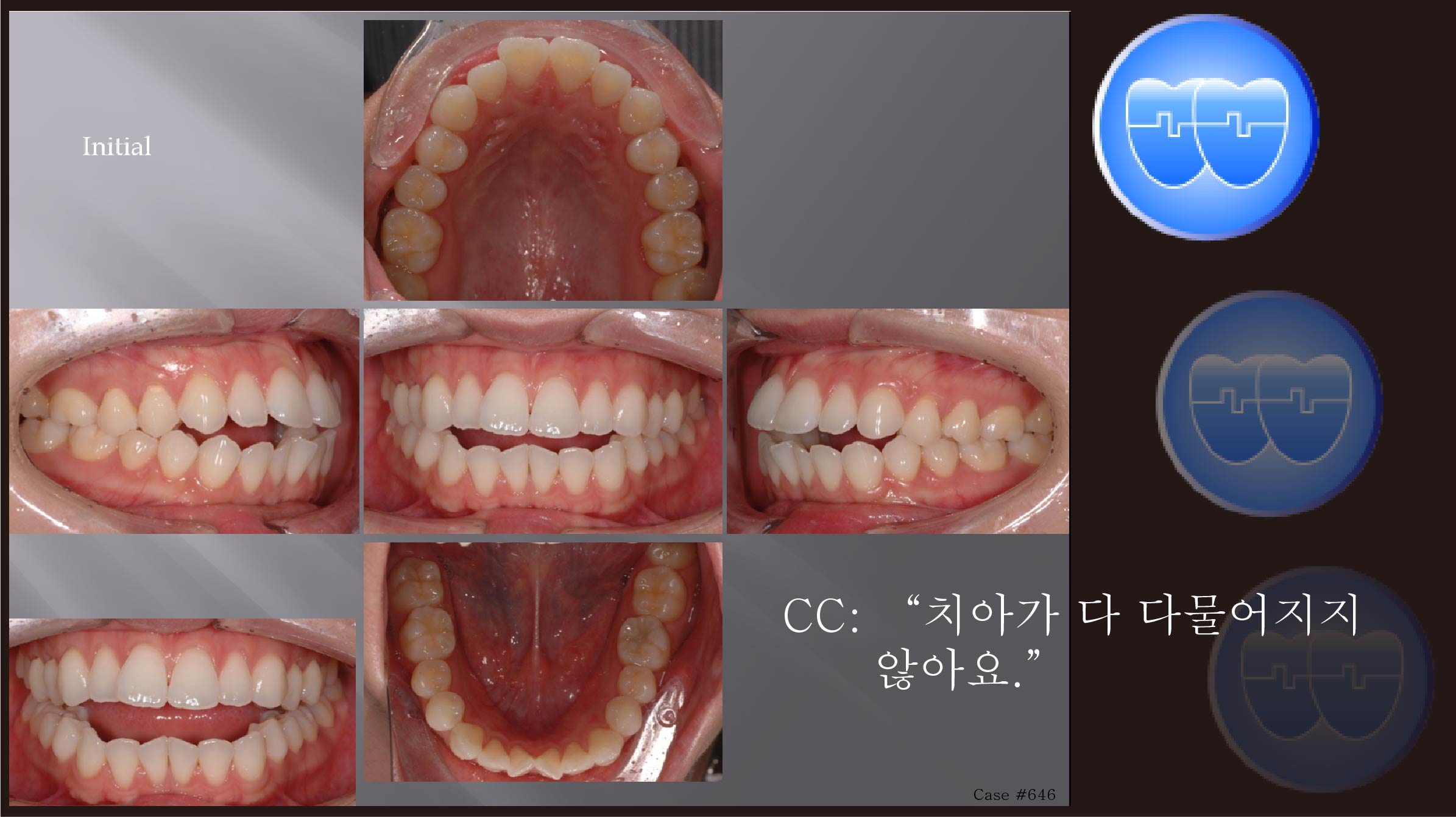 교정 Case 646.  U5L5 발치, Dental Openbite, Protrusion, Sem #7