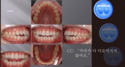 교정 Case 646.  U5L5 발치, Dental Openbite, Protrusion, Sem #7