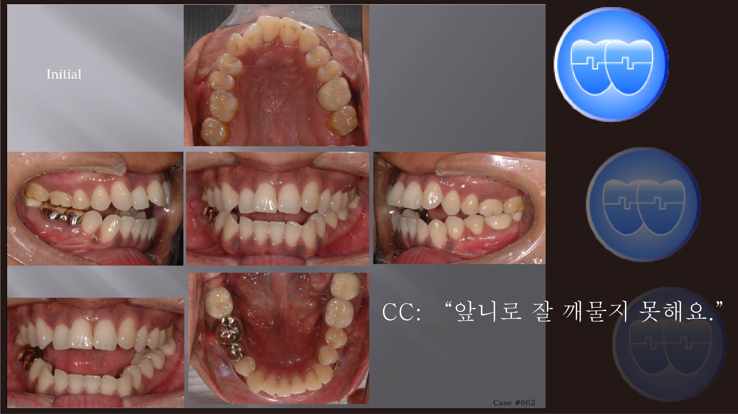 교정 Case 662.  비대칭 발치(15, 22, 36, 47번 발치), Sem #7