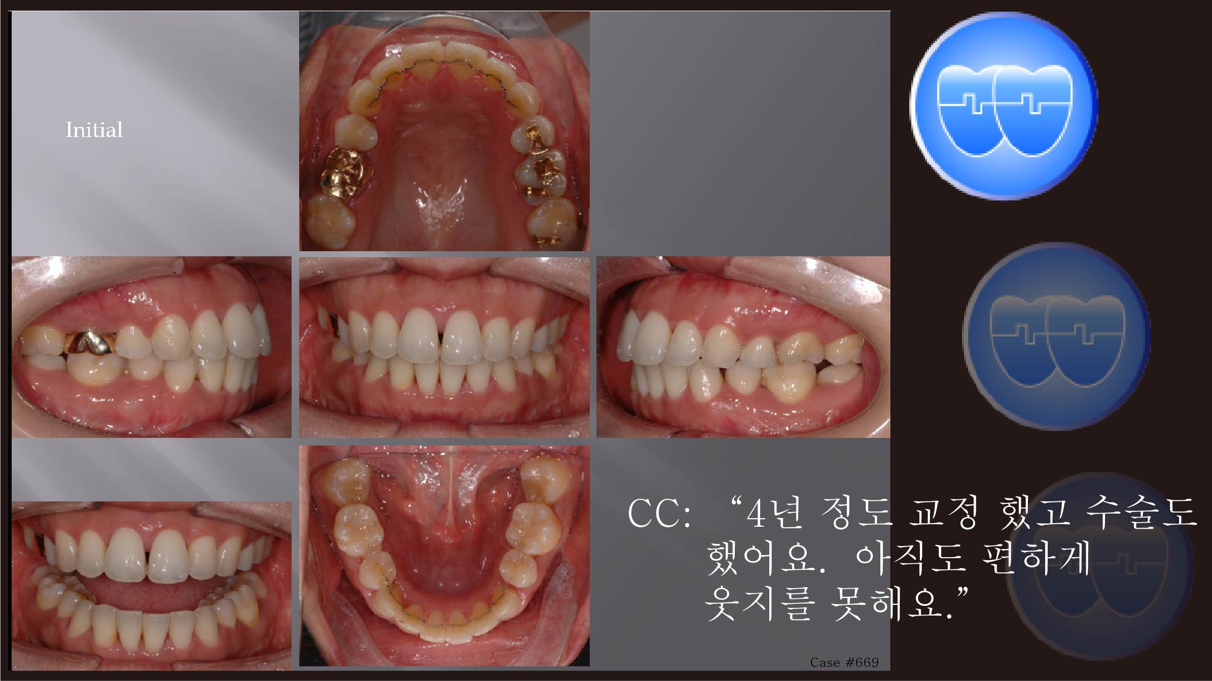 교정 Case 669.  U4L4 발치, 재교정, Severe Gummy Smile, Sem #7.5