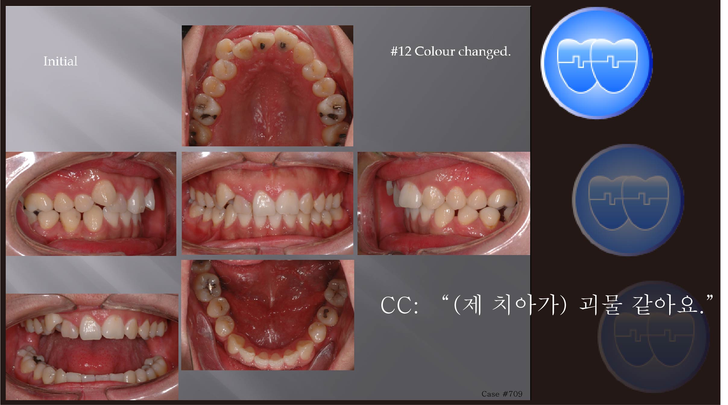 교정 Case 709.  12번 발치, 22번 Congenital Missing, Skeletal Class II, Skeletal Resistance, Root Resorption, Prosth-Ortho, Sem #13