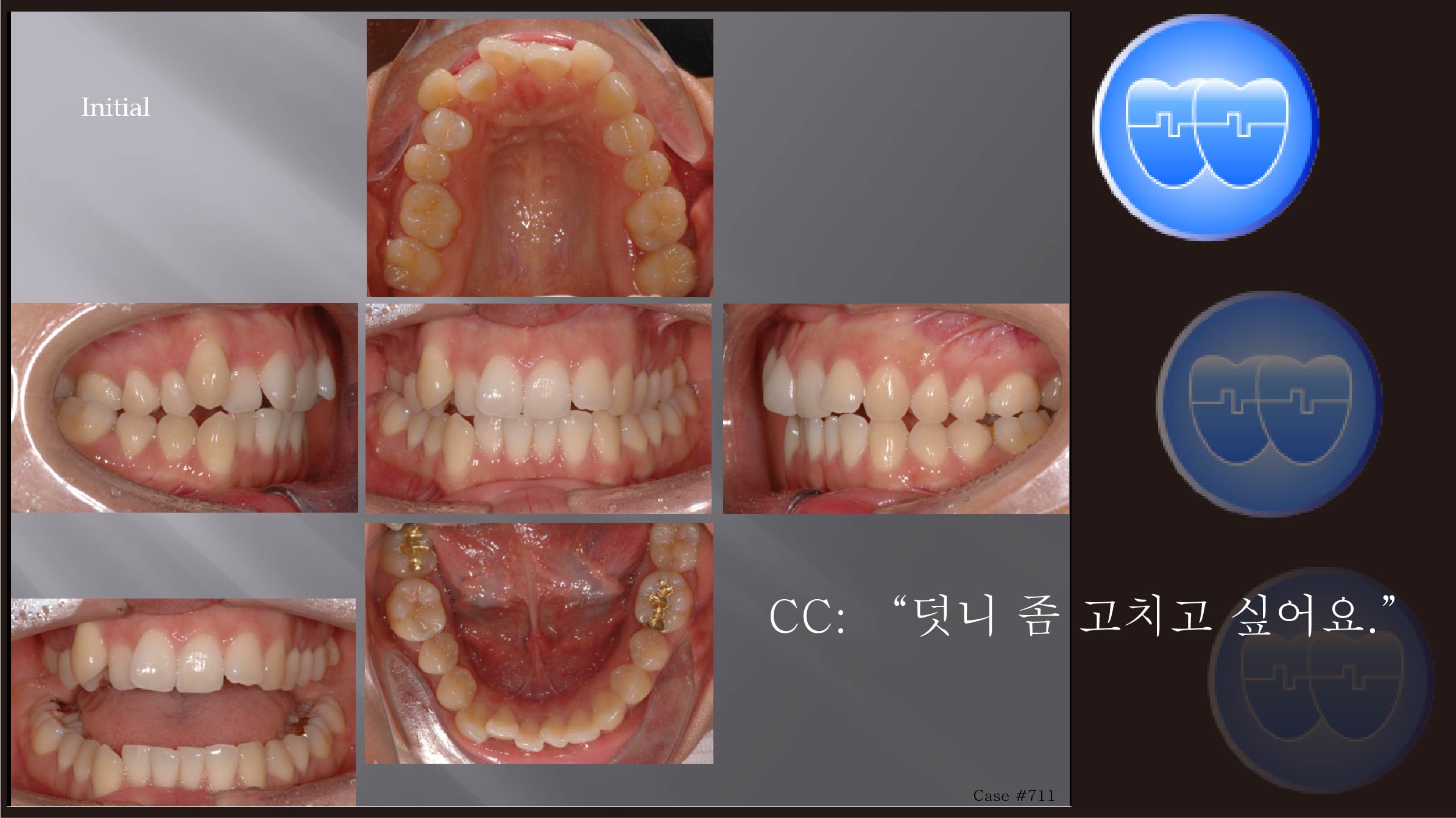 교정 Case 711.  U5 발치, Class II, 시갈버튼, Bilateral Posterior Crossbite, Sem #7.8