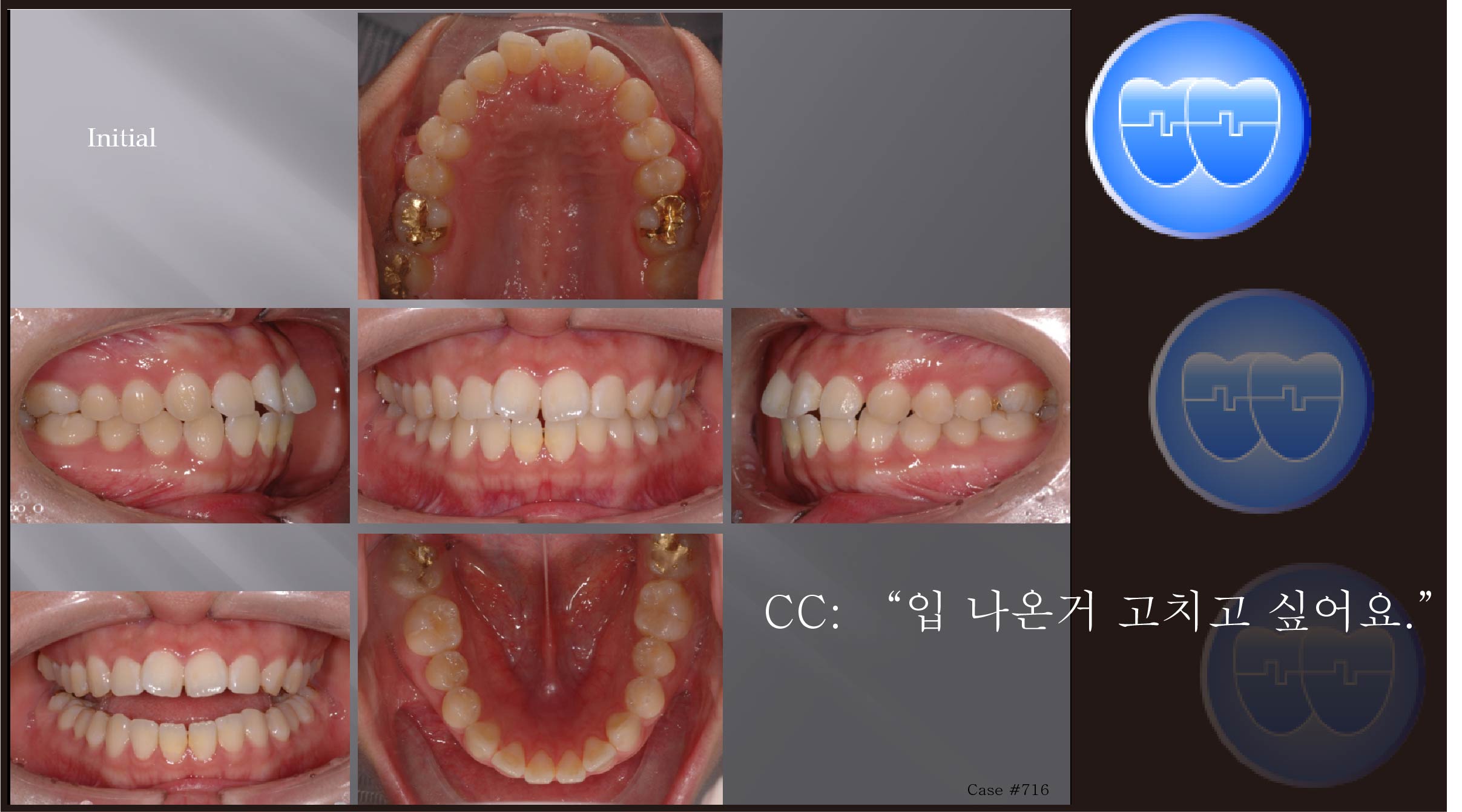 교정 Case 716.  U5L4 발치, Protrusion, Root Resorption, Detorqued Incisors, Sem #12.3