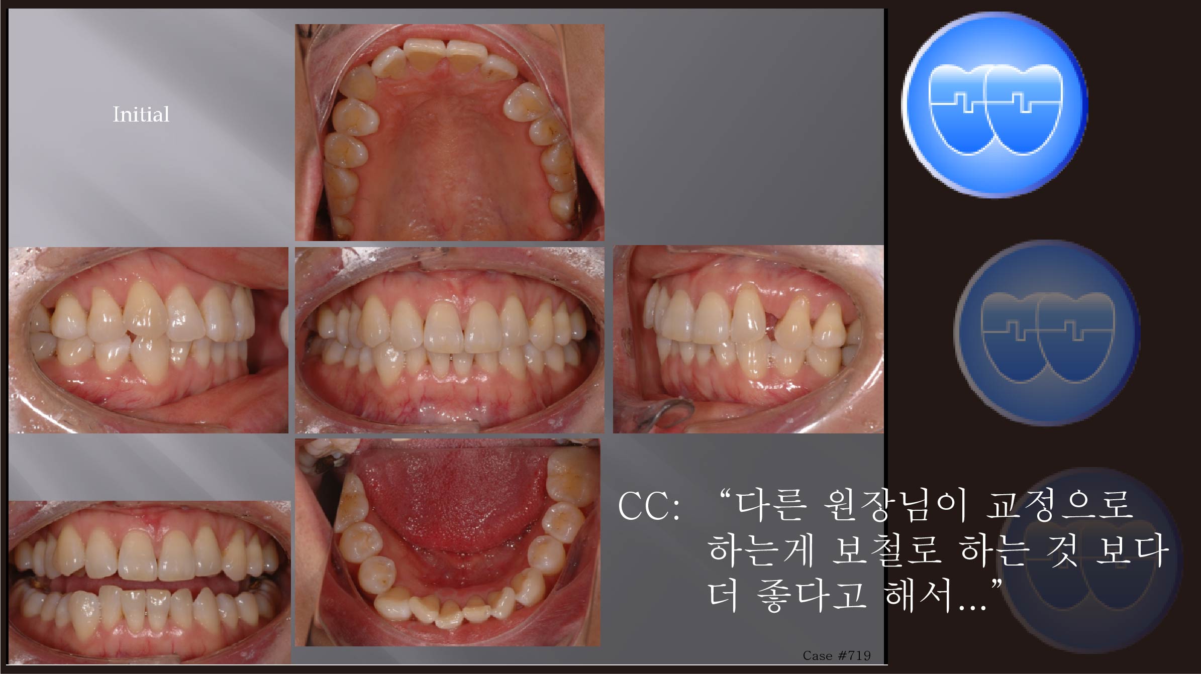 교정 Case 719.  비대칭 발치, U2U5L1 발치, Sem #13.0 & #13.2