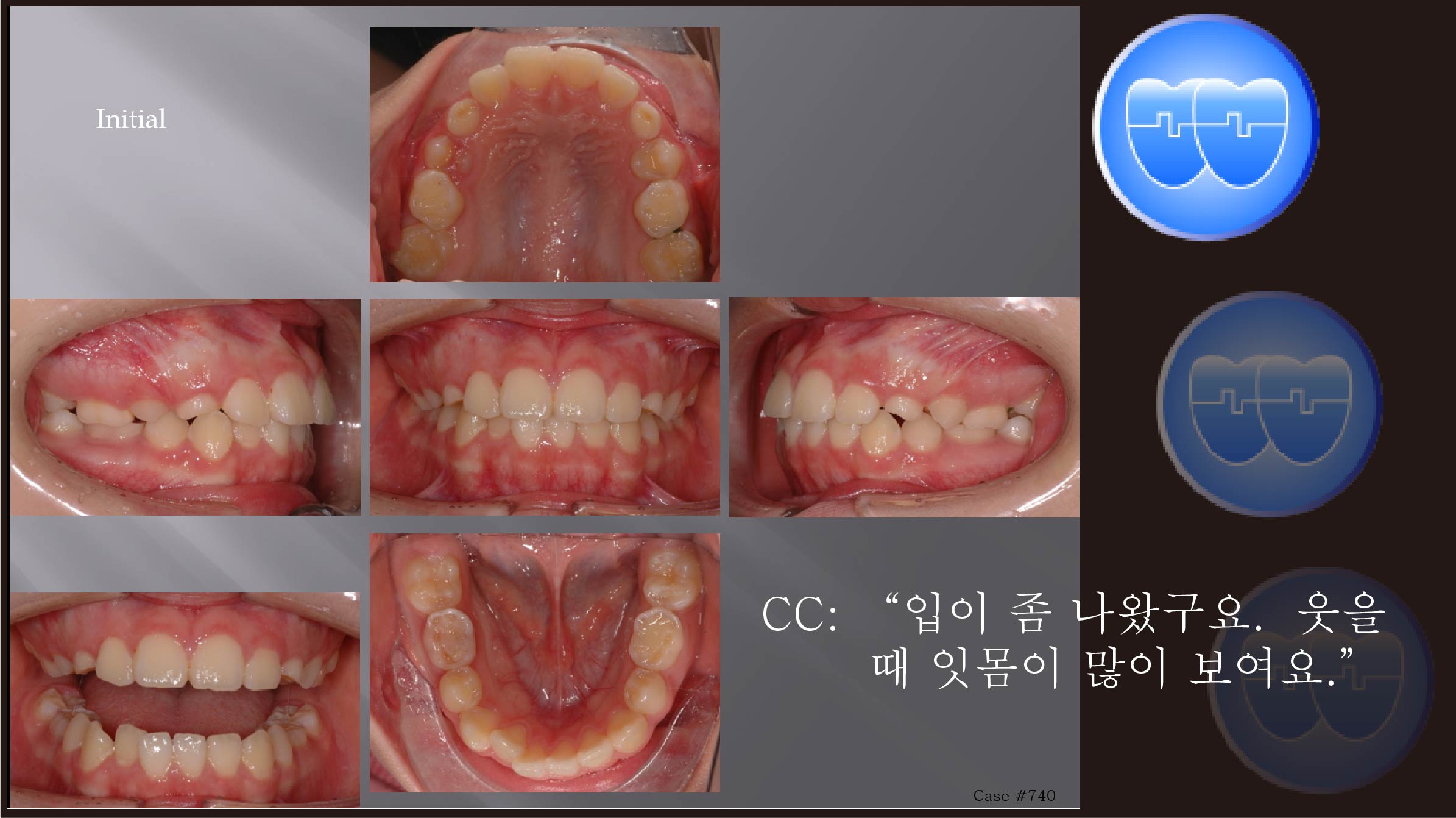 교정 Case 740.  비발치, Arch Expansion, Miniscrew Root Perforation, Sem #5.5