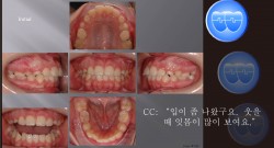 교정 Case 740.  비발치, Arch Expansion, Miniscrew Root Perforation, Sem #5.5