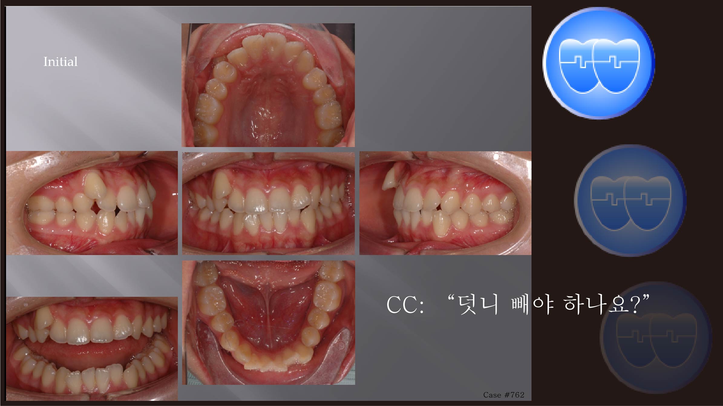 교정 Case 762.  U5L5 발치, Gingival Recession, Sem #12.4