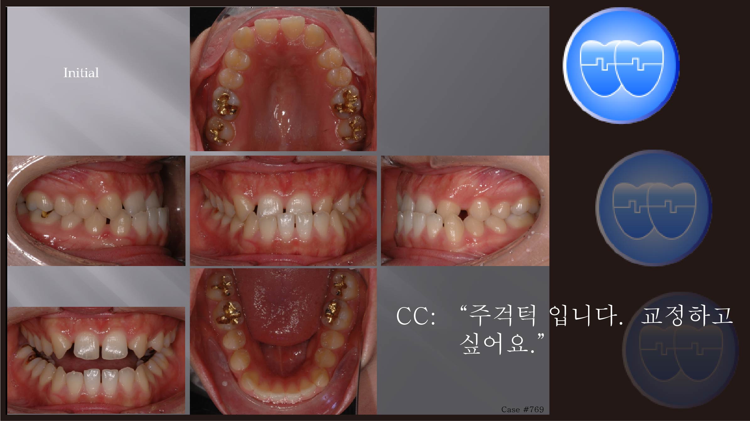 교정 Case 769.  U2L4 발치, Anterior Crossbite, Congenital Missing of #12, #22, Sem #13