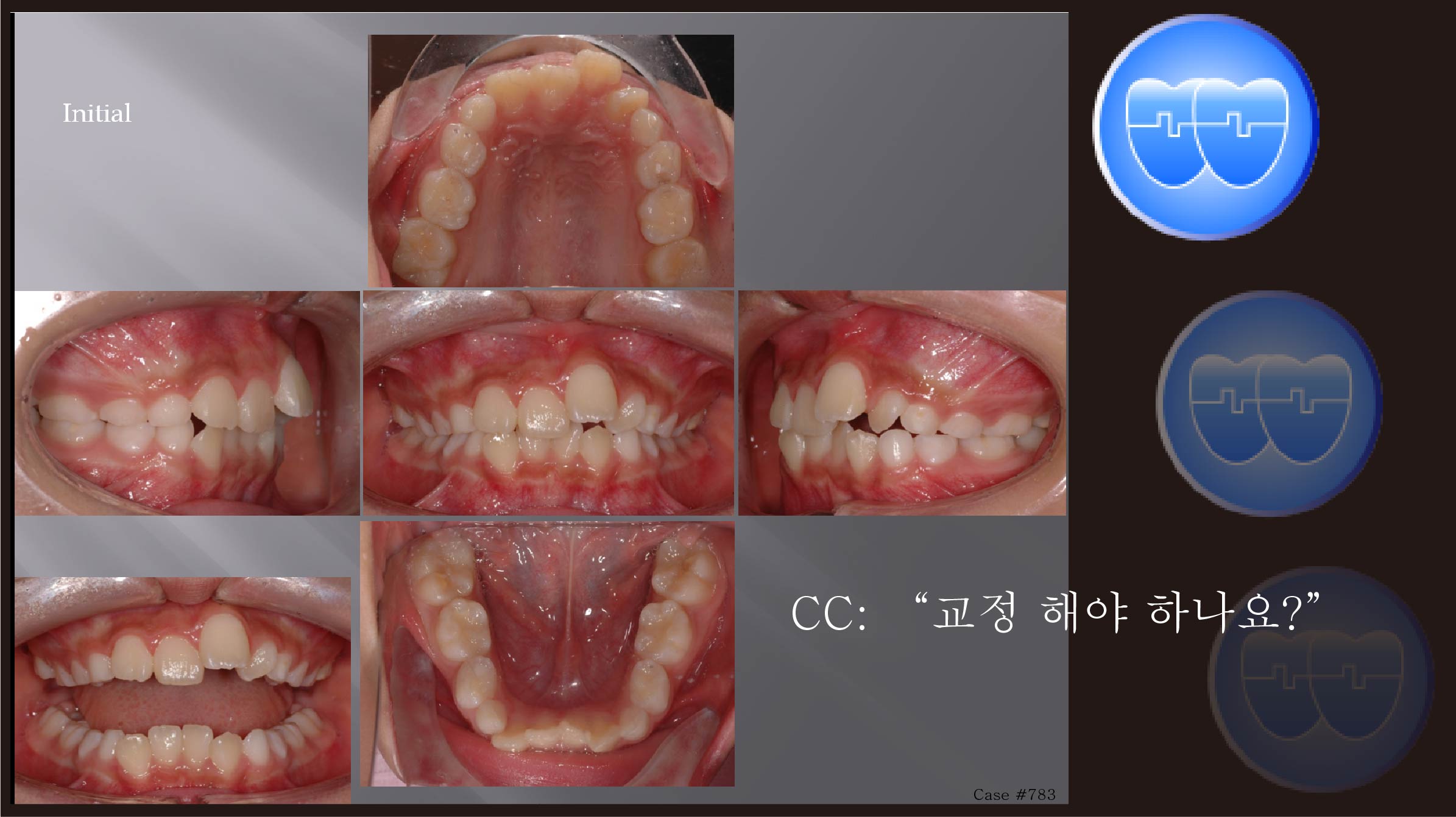 교정 Case 783.  1차 교정, Leveling, Sem #9