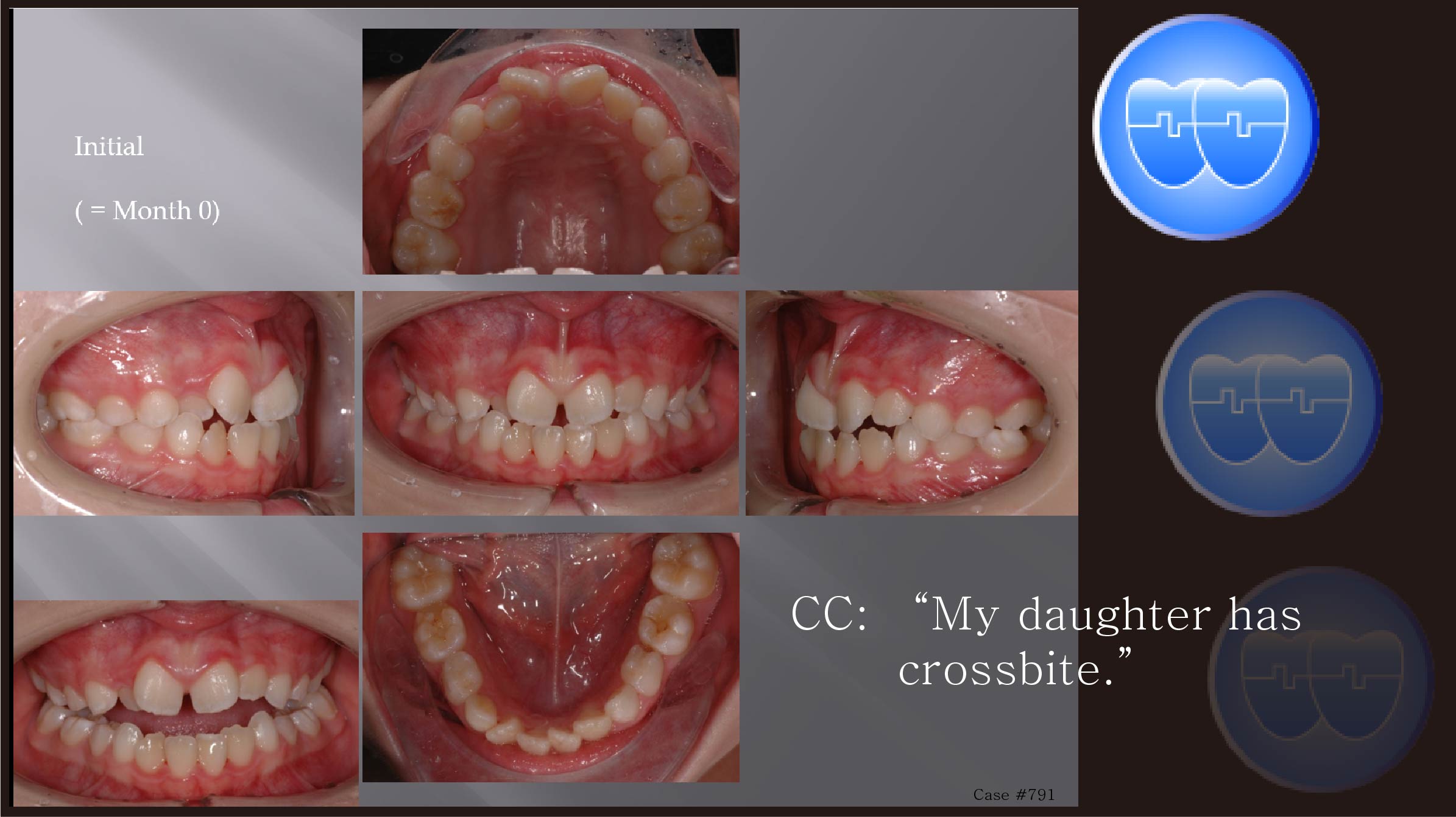 교정 Case 791.  1차 교정, Anterior Crossbite, Sem #9