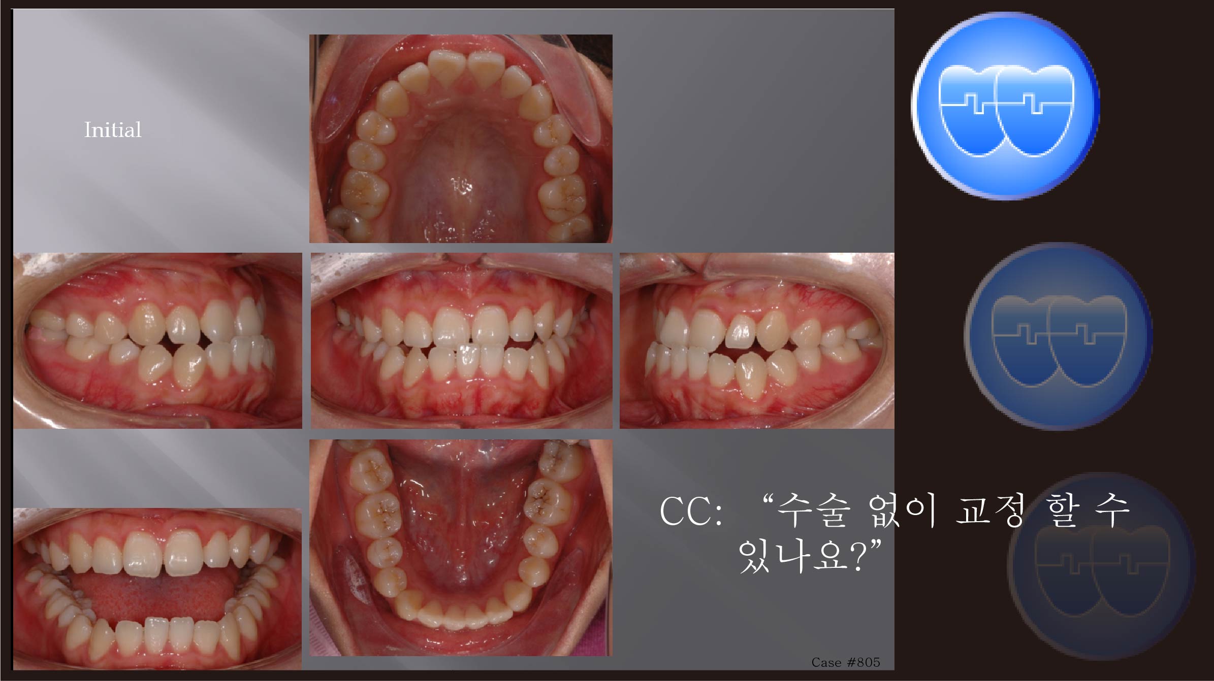 교정 Case 805.  L4 발치, Openbite, Lower Lingual Corticotomy, Sem #7