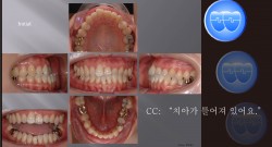 교정 Case 821.  비발치, Tilted Occlusal Table, Anterior Crossbite, Functional Shift, Lower Lingual Corticotomy, Sem #7.7