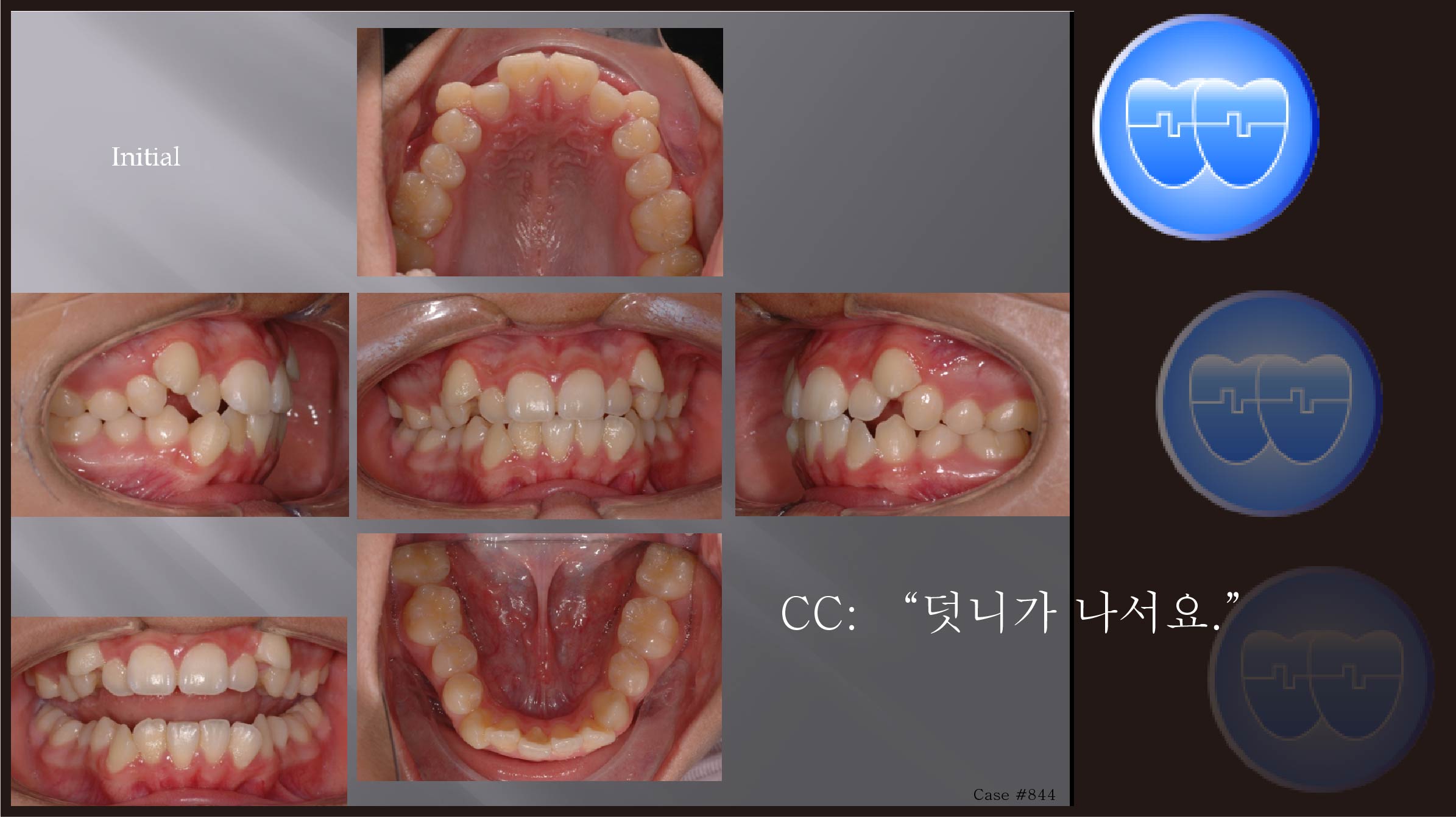 교정 Case 844.  U4L4 발치, High Canine, Sem #12.1