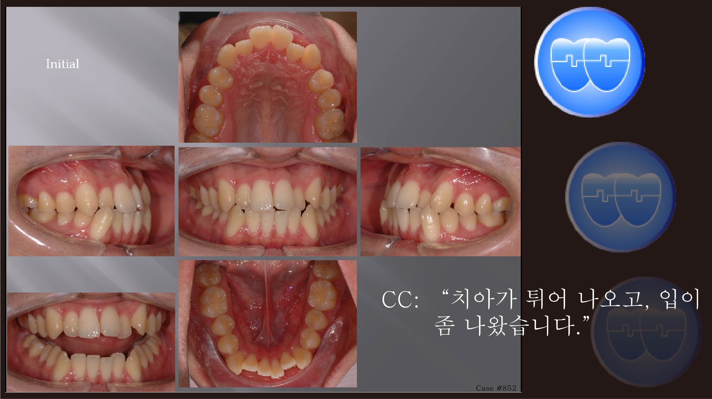 교정 Case 852.  U5L4 발치, Damon Bracket, #43 신경 죽음, Sem #12.3